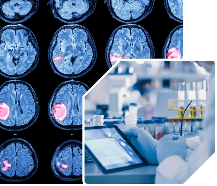 Brain cancer market opportunity and patient population data